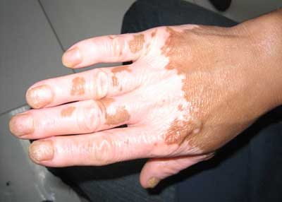 导致白癜风病情加重的原因有哪些?