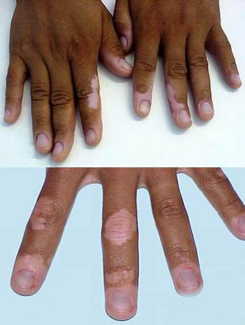 有哪些措施可以预防白癜风