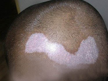 白癜风的物理因素有哪些