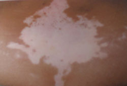 白癜风用药需要注意什么