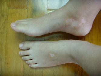 白癜风治疗难点有哪些