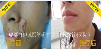 白癜风自我诊断的方法有哪些