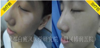 辐射对白癜风治疗有哪些影响