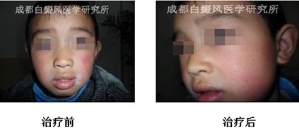 白癜风有哪些典型的症状