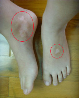 白癜风患者要怎样自我诊断