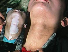 诊断白癜风的标准有哪些