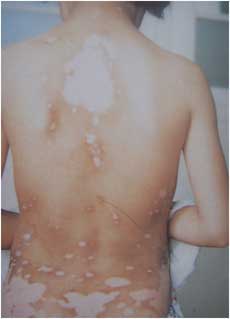 °×ñ°·ç¸¨ÖúÕï¶Ï´ëÊ©ÓÐÄÄЩ