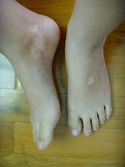 白癜风该如何正确诊断呢