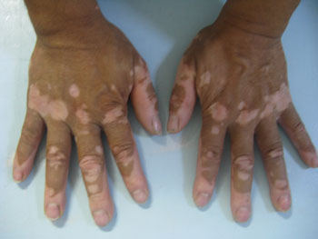 识别白癜风的方法有哪些