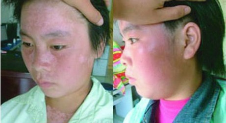 诊断白癜风的注意事项有哪些