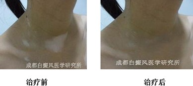 白癜风诊断时要注意什么