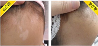 如何才能预防白癜风扩散