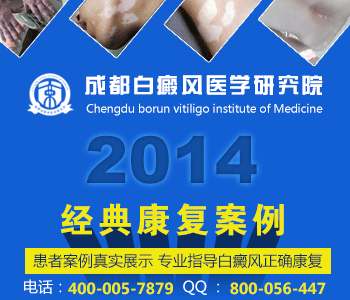 白癜风会有哪些症状呢