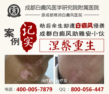 白癜风主要有哪些症状