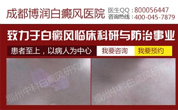 白癜风脸部早期症状